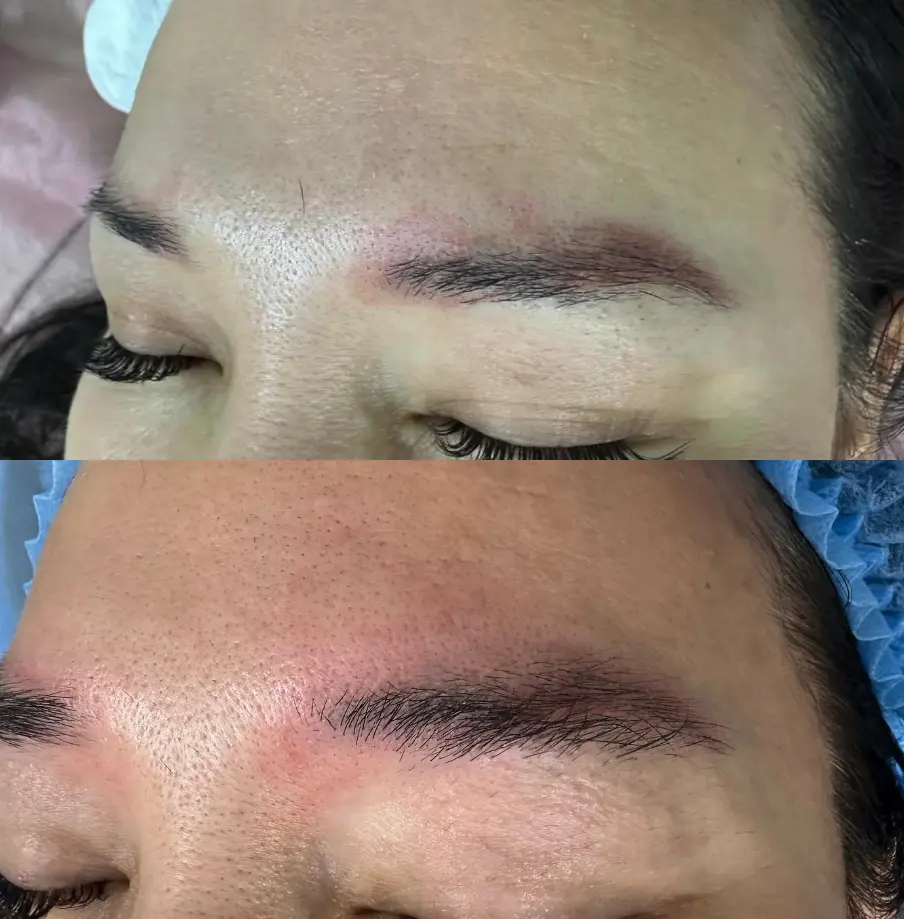 Pros of Laser Tattoo Removal
