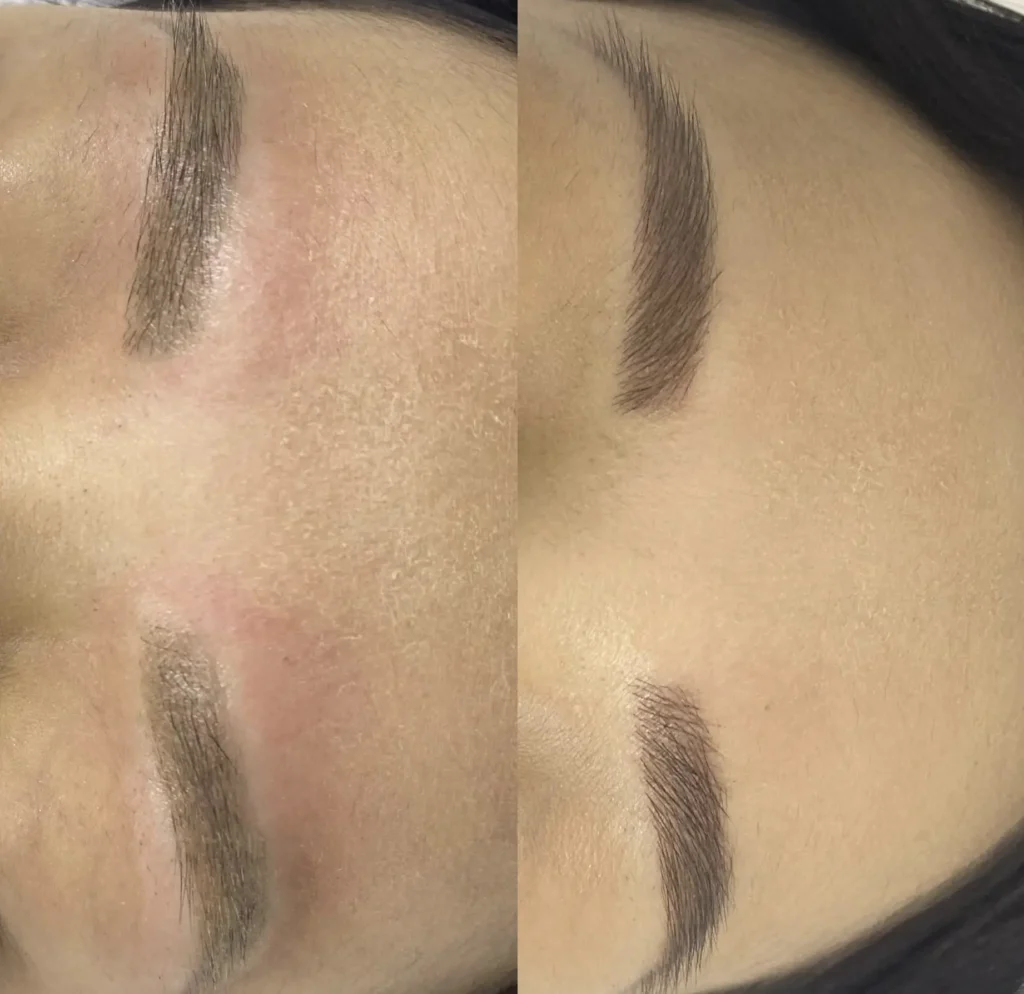 Safe Eyebrow Tattoo Removal