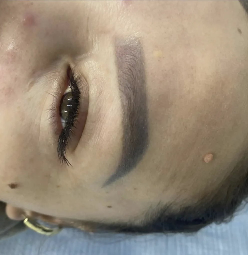 brow tattoo removal