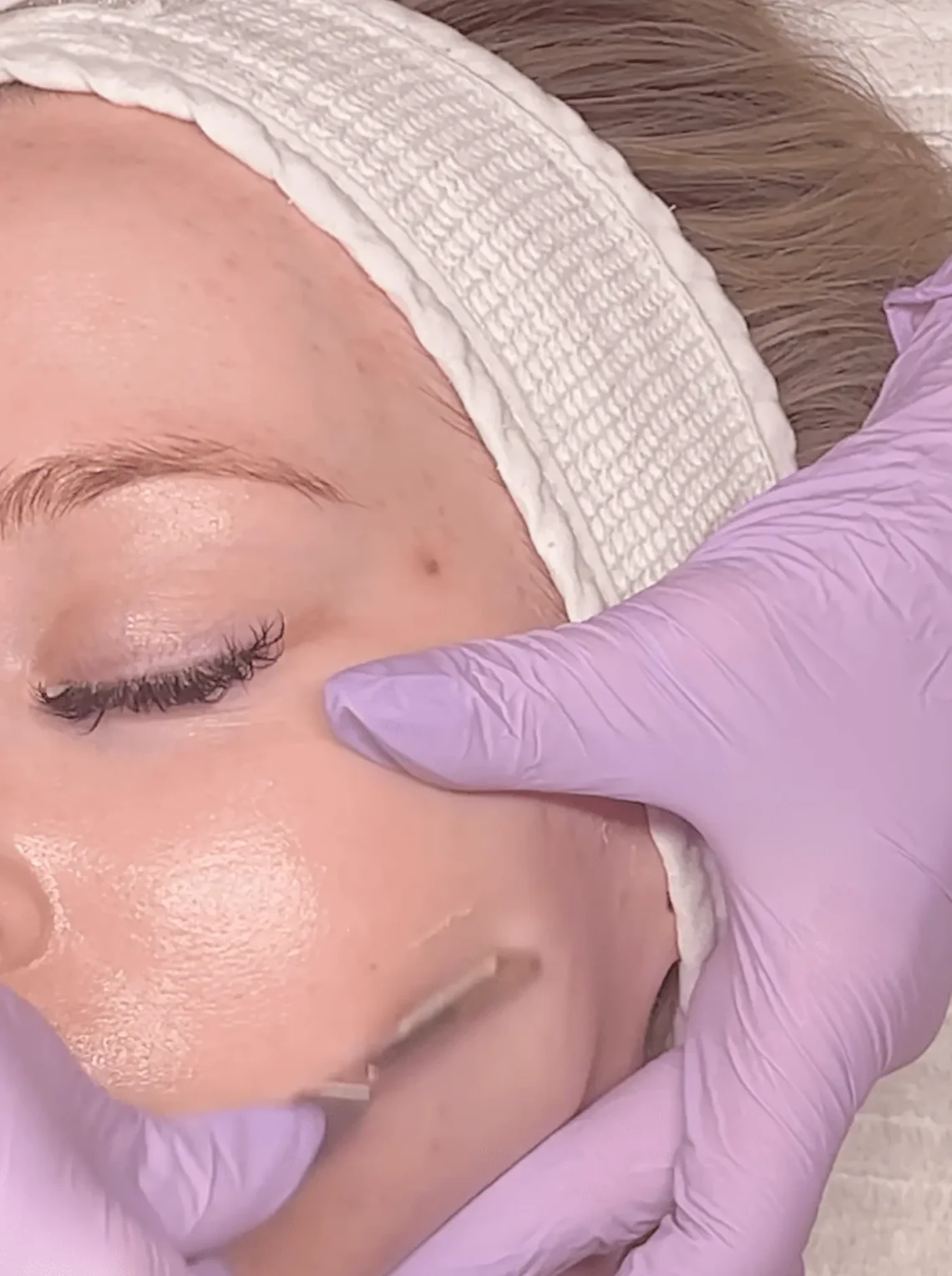 dermaplaning