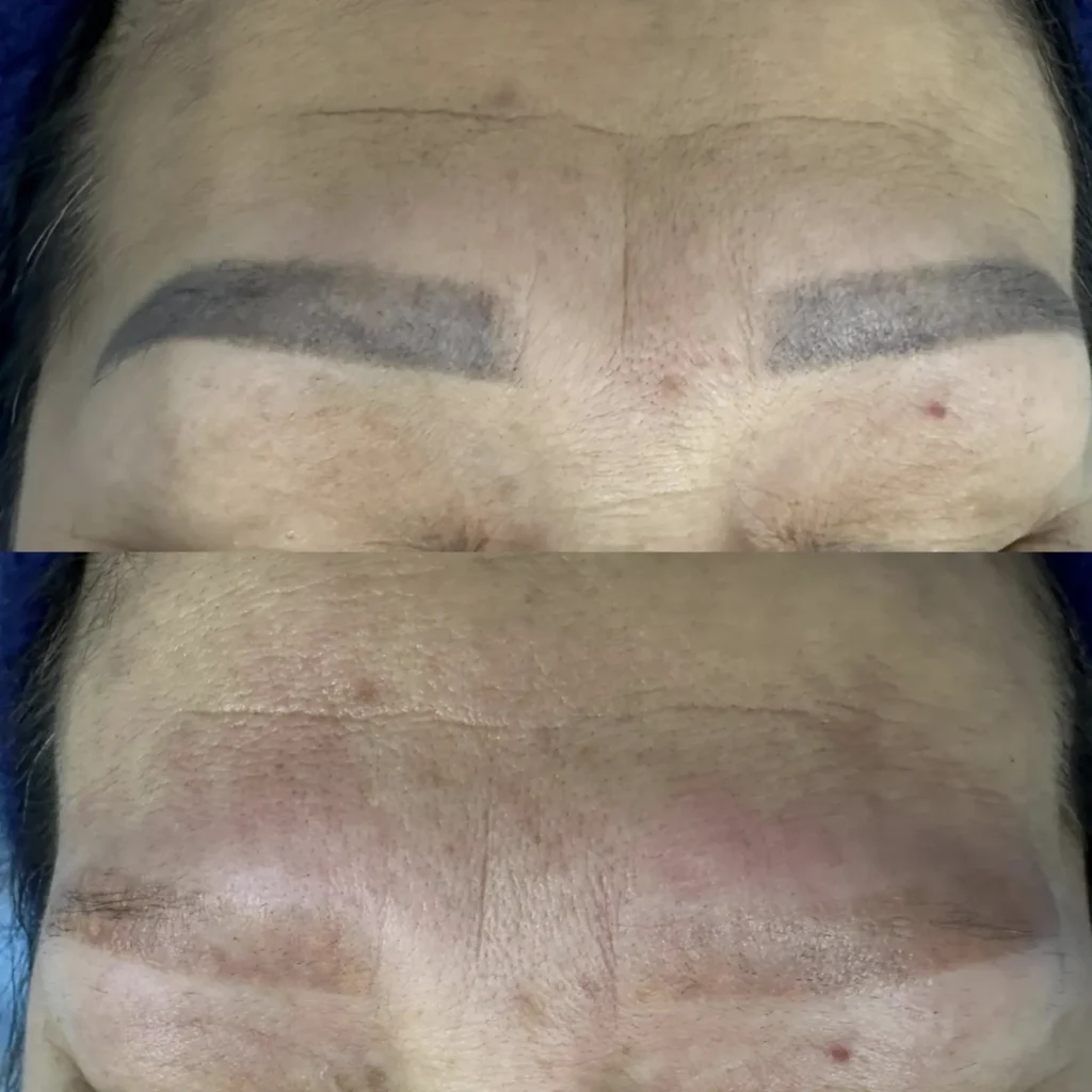 eyebrow laser tattoo removal