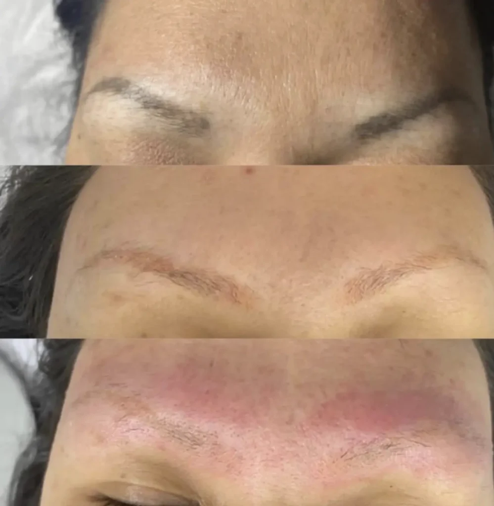 eyebrow tatoo removal
