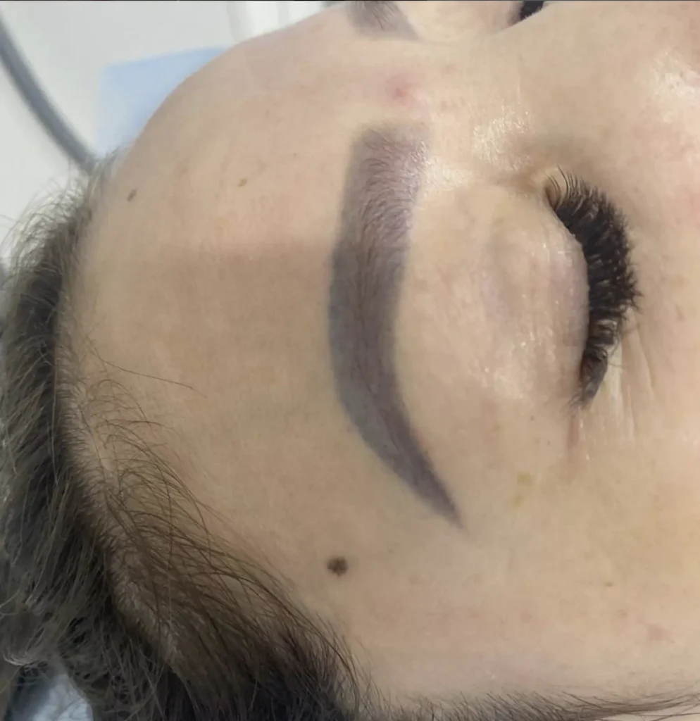 eyebrow tattoo laser removal