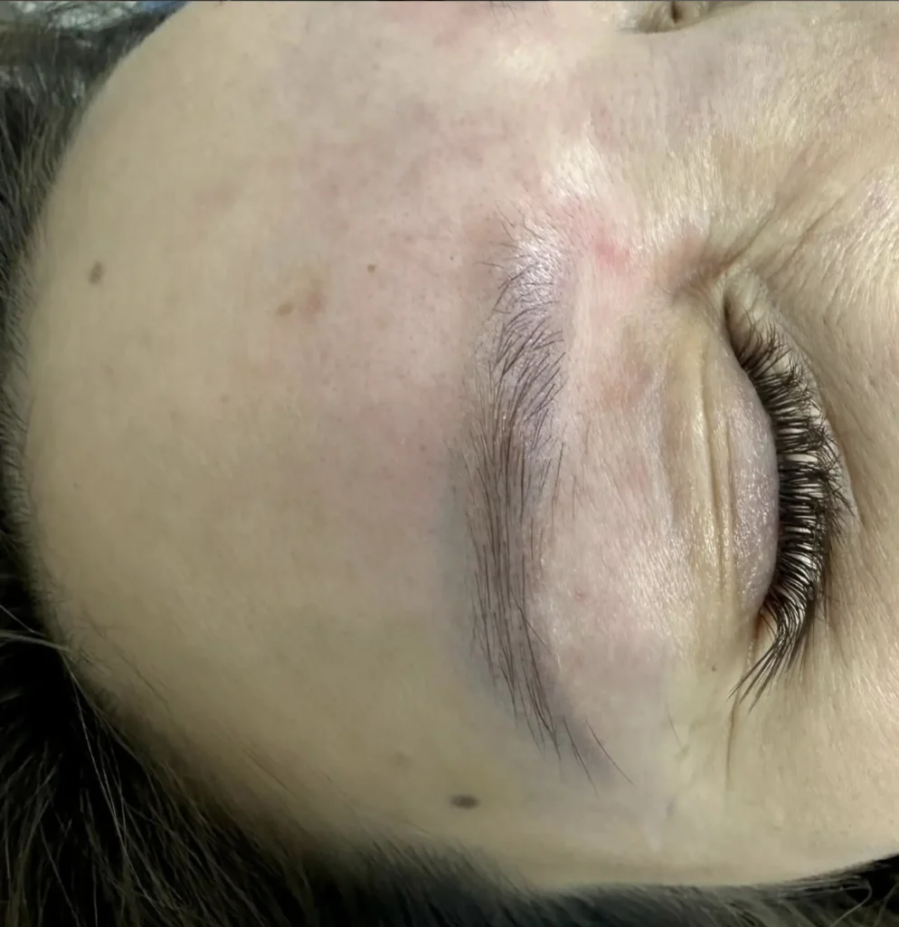 eyebrow tattoo removal
