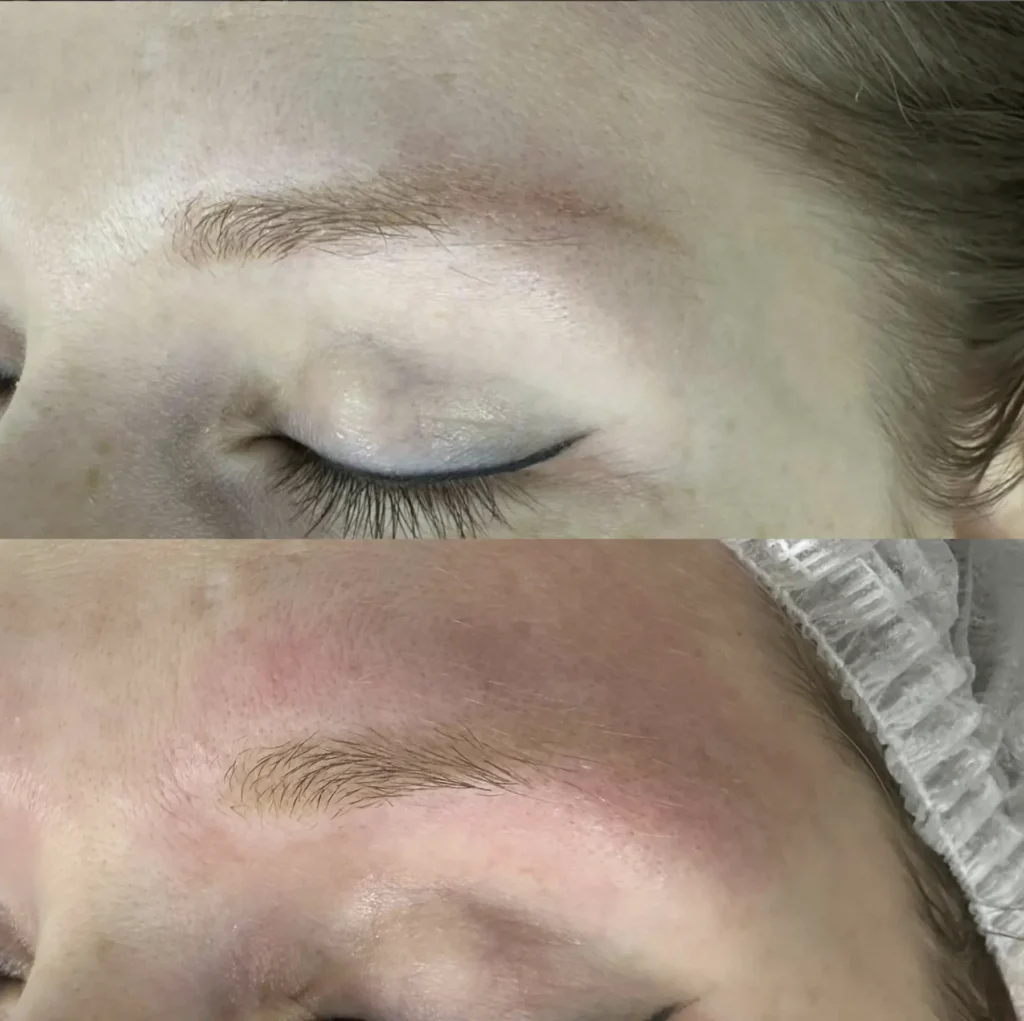 eyebrow tattoo removal melbourne