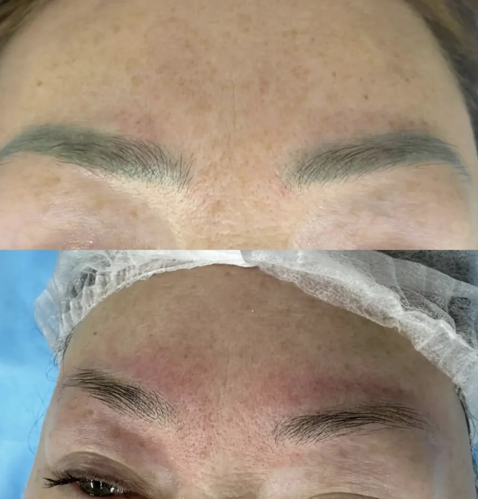 eyebrow tattoo removal near me