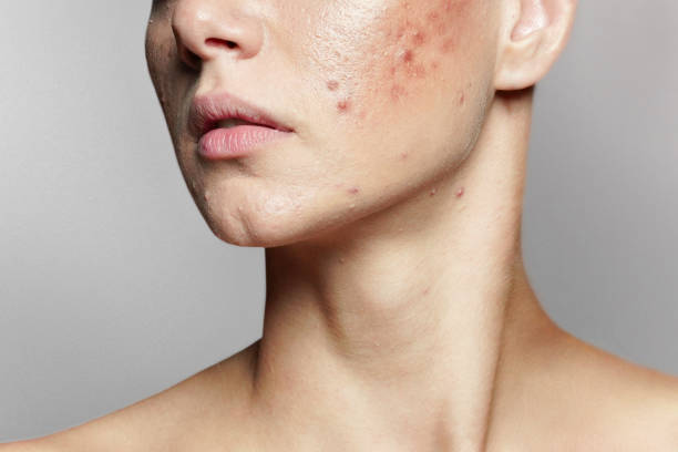Effective Microneedling Treatment for Acne Scars: Transform Your Skin with Advanced Techniques