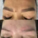 laser eyebrow tattoo removal