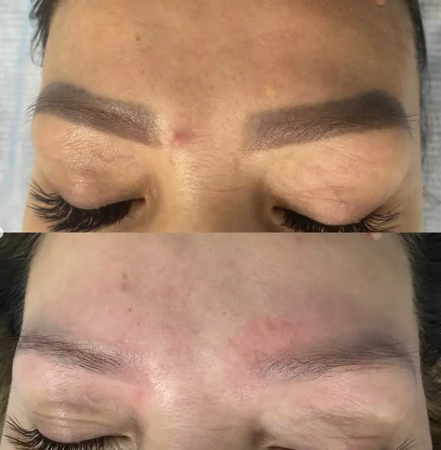 laser eyebrow tattoo removal