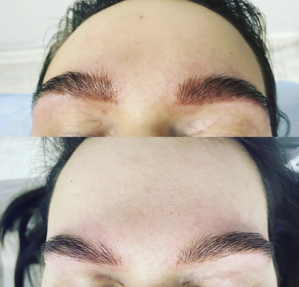microblading removal
