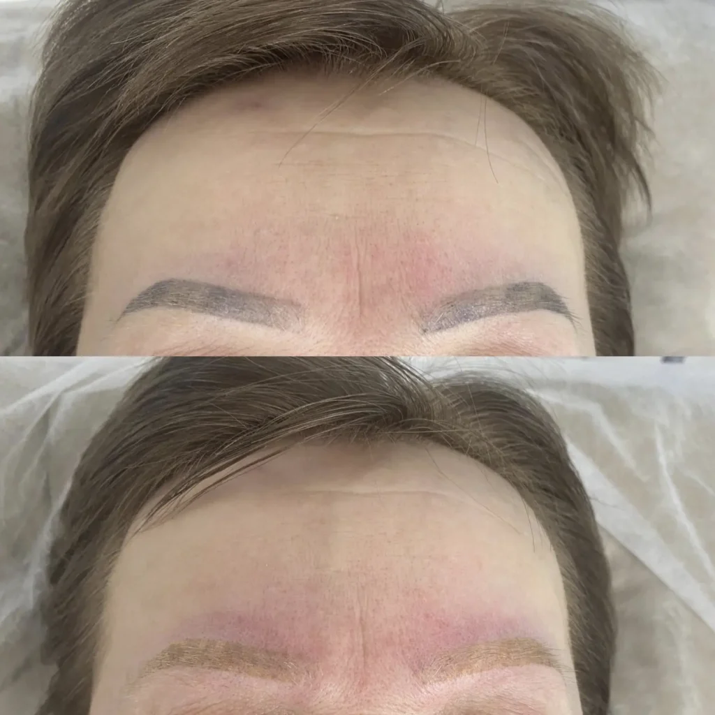 remove eyebrow tattoo